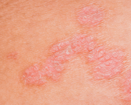 атопичен дерматит