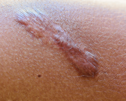 Терапия на червени и светлокафяви навдигнати белези с късоимпулсен QS-KTP лазер