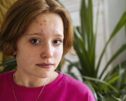 Терапия на червени навдигнати белези с KTP лазер